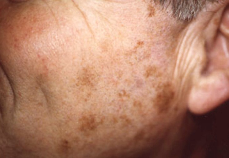 Facial Skin Spots 54