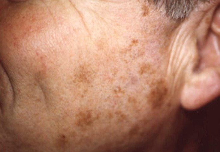 What Causes Brown Liver Spots On Skin