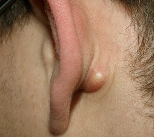 What is the cause of sinus pain behind the ear ...