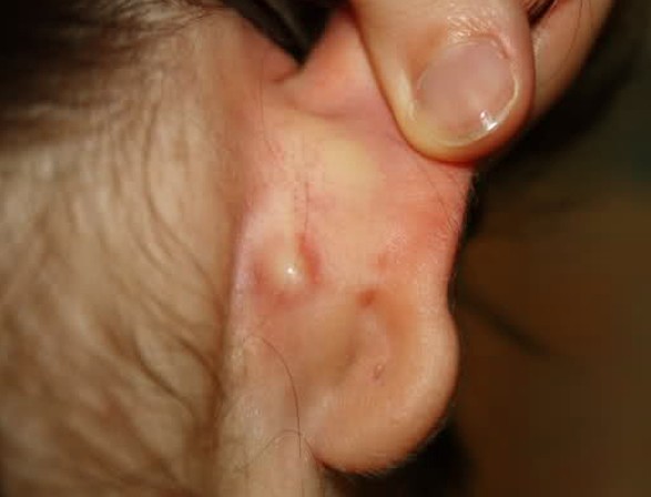 Ear Lump - Symptoms, Causes, Treatments - Healthgrades