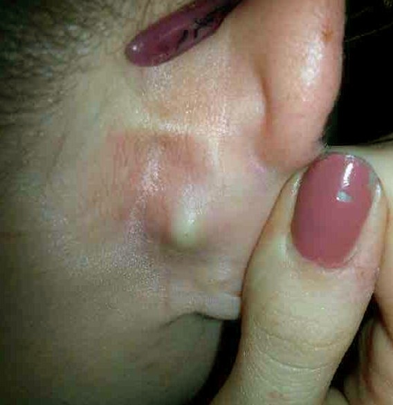 How can swollen lymph nodes in front of the ear cause 