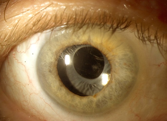 11 Causes & Treatments for Pain Behind Eye