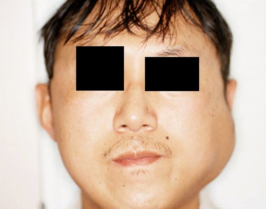What is an infected parotid gland?
