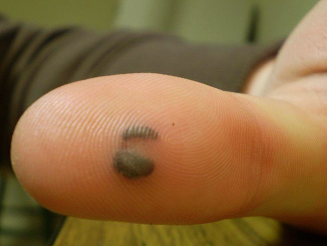 infected-blood-blister-on-finger