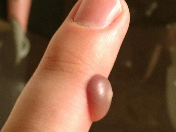 Blood Blister on Finger | Med-Health.net