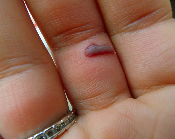 blister on finger #9