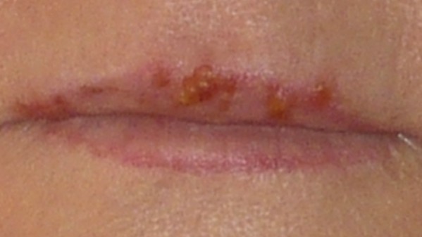 Bumps On Lips Causes Treatment Pictures