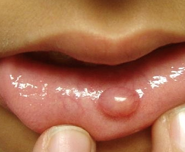 bumps on lips pictures #10