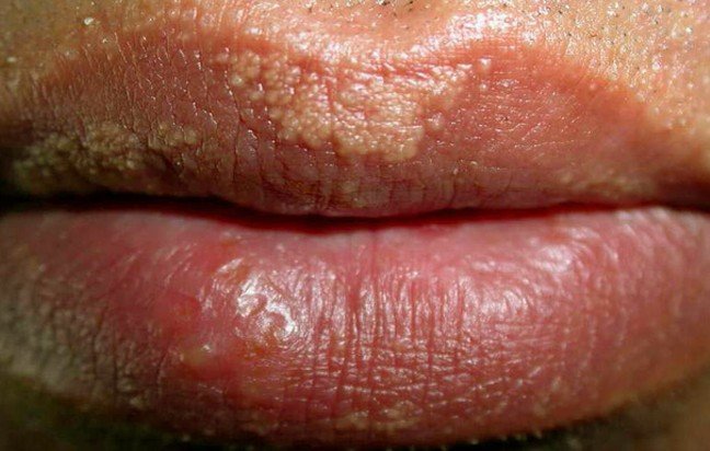 what-causes-white-bumps-on-lips-how-to-treat-it