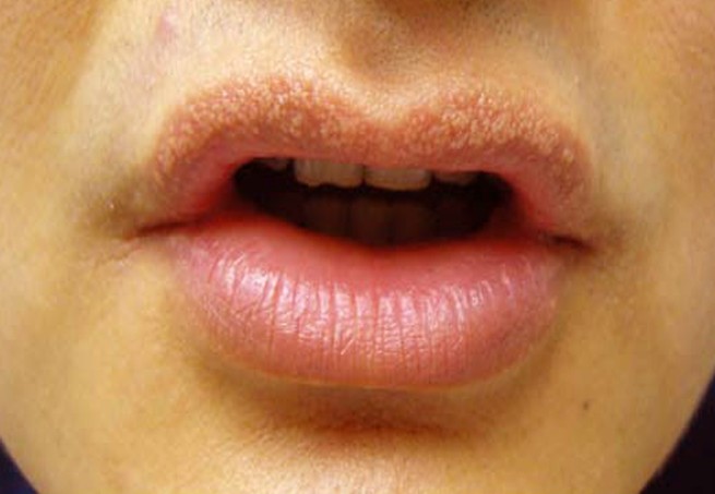 small herpes on lips
