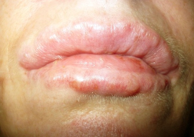 bumps on lips pictures
