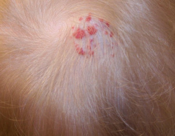 Itchy Scalp & Inside Ears - Dermatology - MedHelp