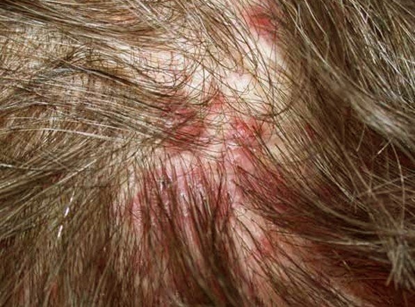 Causes of a Rash on the Scalp Skin | LIVESTRONG.COM