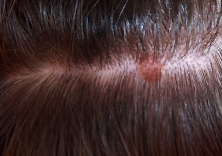 itchy scalp red spots - MedHelp