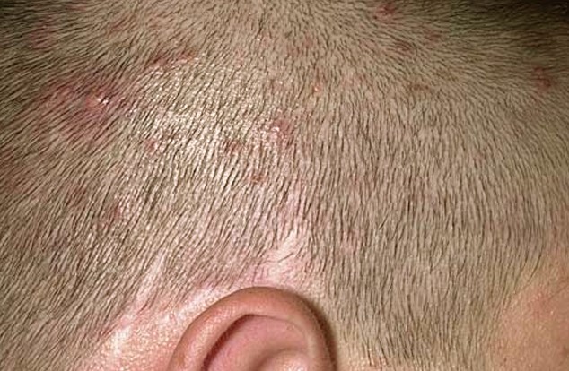 bumps on scalp pictures