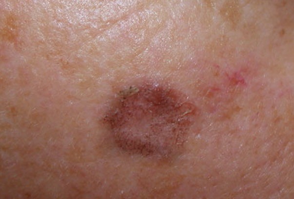 Lichenoid Keratosis - Pictures, Symptoms, Causes, Treatment