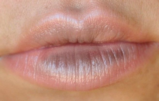 blue spots on lip