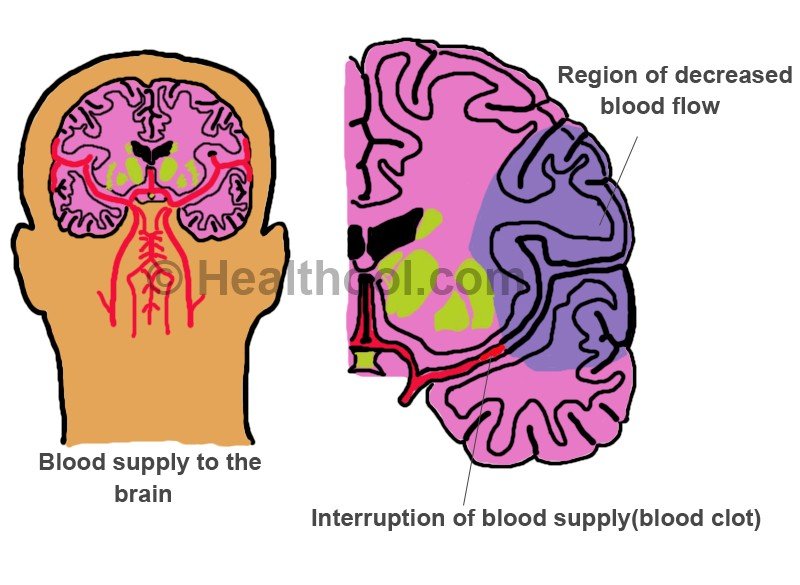 Blood Clots in the Brain Symptoms, Causes, Treatment