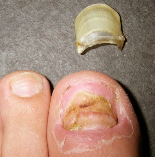 black-spot-under-the-toenail-the-diagnosis-and-treatment-guide