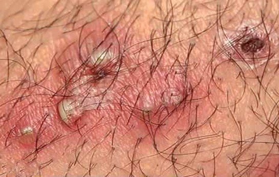 hair cyst #10