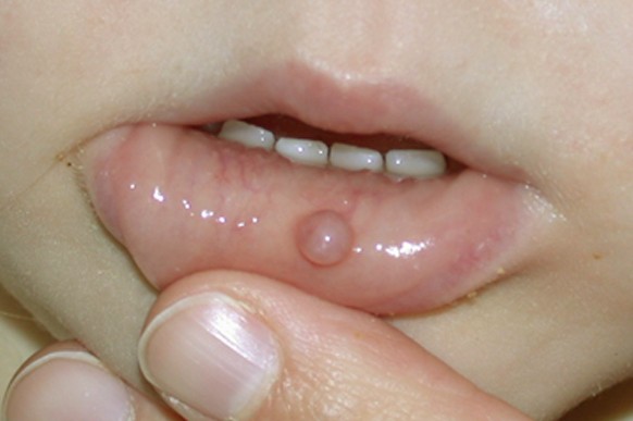 mucous retention cyst lip