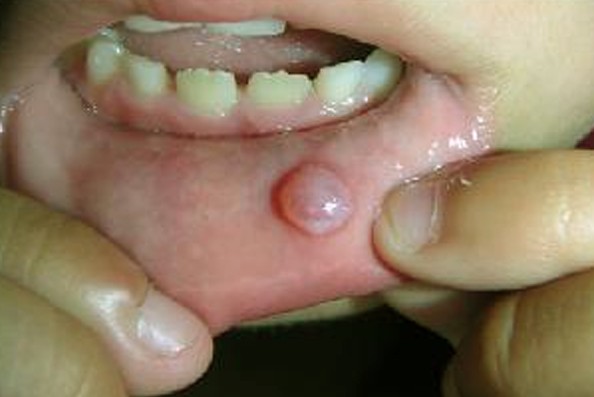 Mucocele (speekselklier cyste) op de lip (patientenfolder)