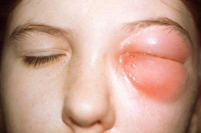 Picture of Orbital Cellulitis in Adult