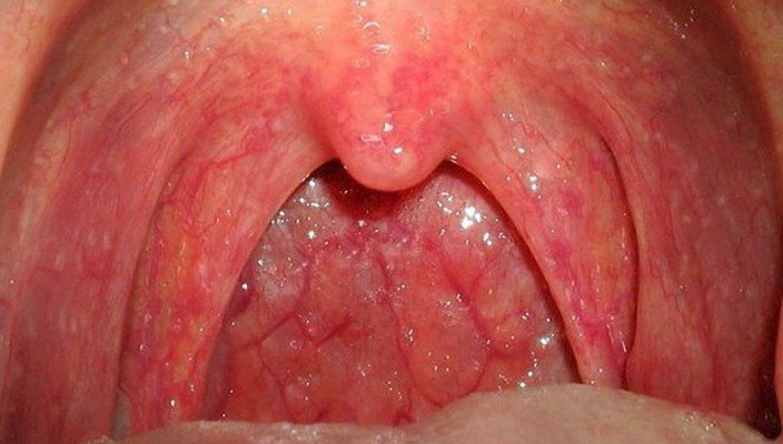 Inflammation In The Throat 121