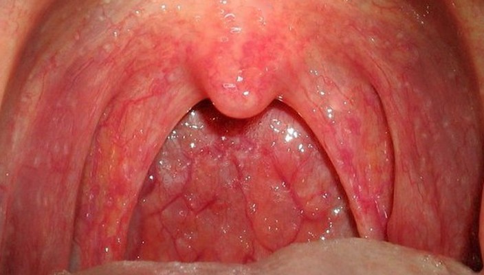 One Side Of Throat Swollen 92
