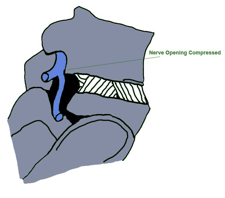 Retrolisthesis of l3 on l4