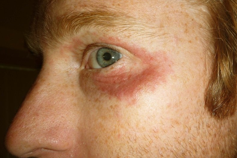 What Causes Red Spots Under My Eyes