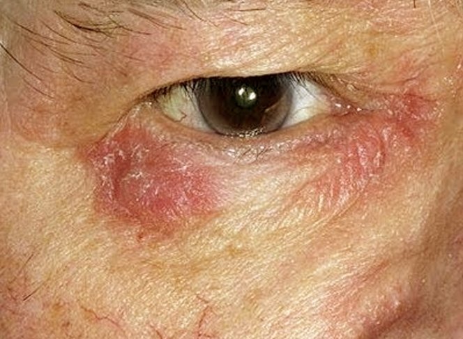 redness skin around eyes