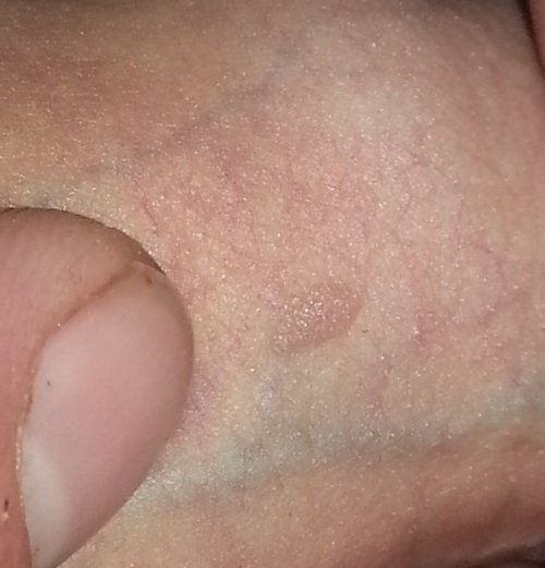 Pictures Of Rashes On Penis 77
