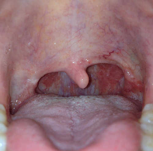 Throat And Uvula 33