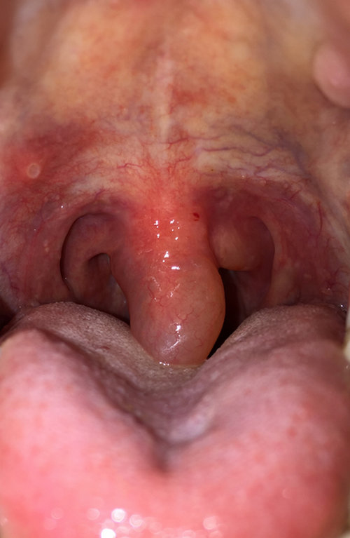 Throat And Uvula 42