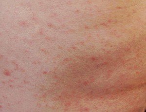 Healthoolmaculopapular rash photos | Healthool