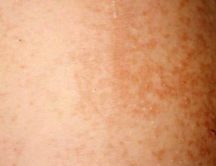  Maculopapular Rash Pictures Causes Treatment Diagnosis January 