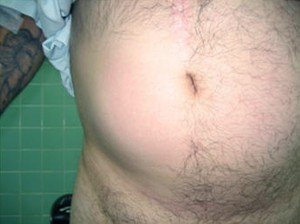 Spigelian Hernia - Pictures, Symptoms, Location, Causes, Treatment