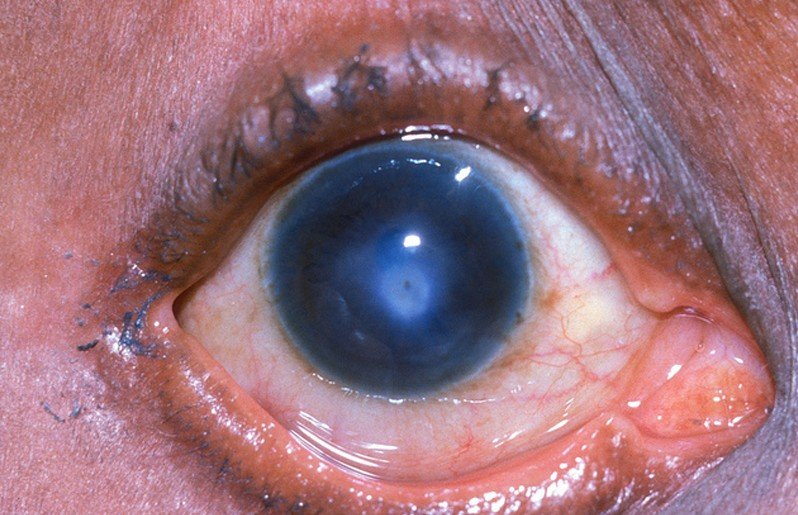 Corneal Ulcer - Pictures, Symptoms, Causes, Treatment ...