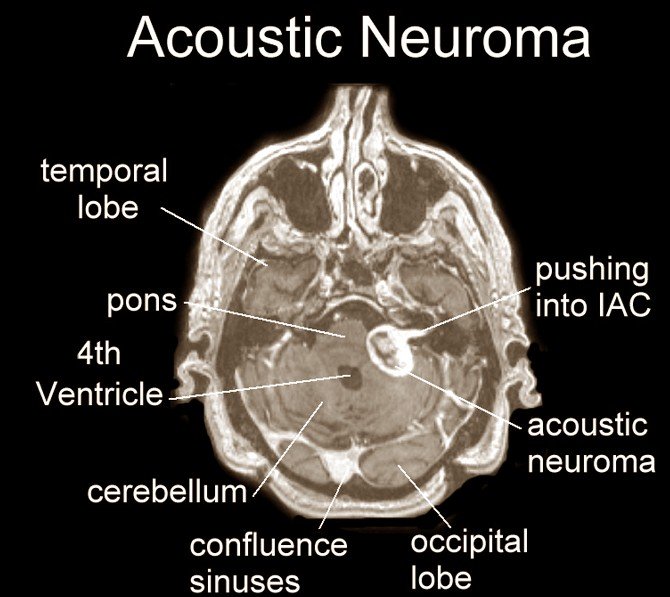 auditory nerve tumor