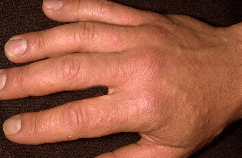 sun-poisoning-pictures-rash-causes-treatment-health-momma