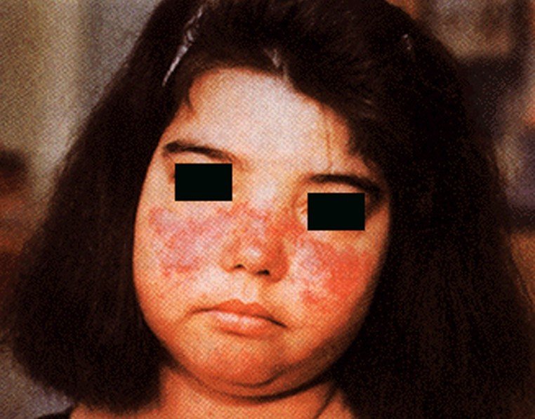 Systemic Lupus Erythematosus Pictures 2 