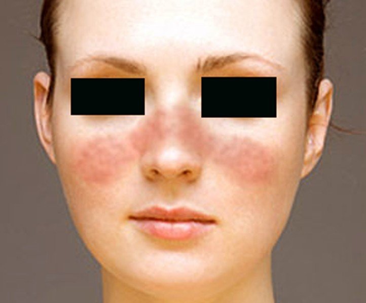 👉 Systemic Lupus Erythematosus - Pictures, Symptoms, Causes, Treatment