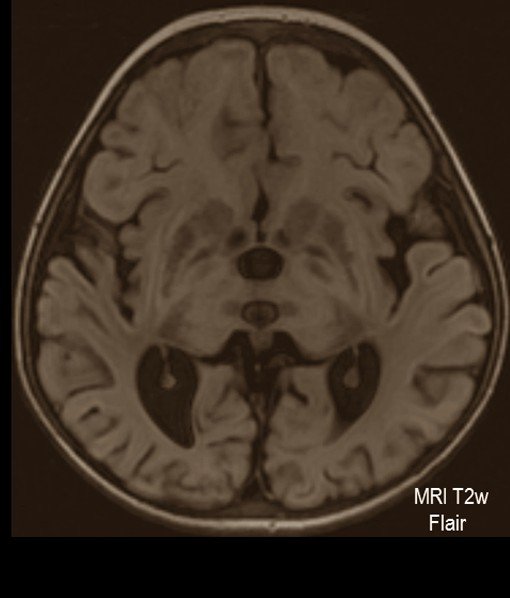 Tay Sachs Disease - Pictures, Symptoms, Causes, Treatment