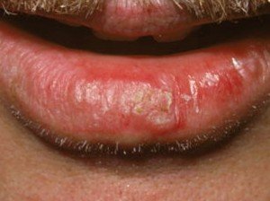 👉 Actinic Cheilitis - Pictures, Treatment, Symptoms, Causes (December 2021)