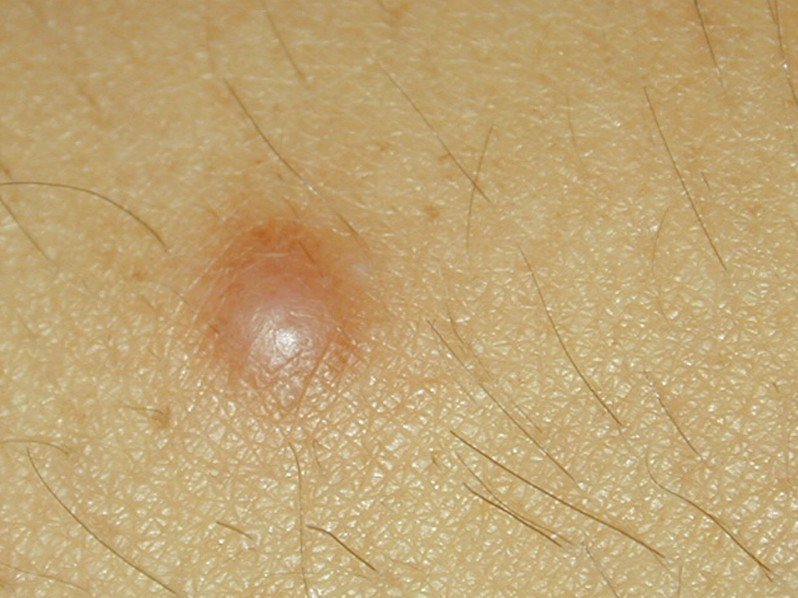 Small Hard Lump Under Skin On Leg