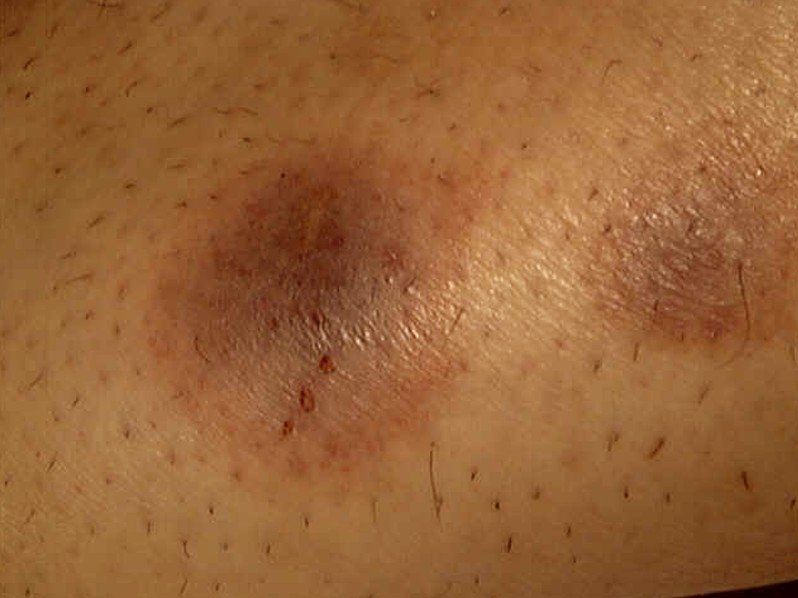 Brown Spots On Skin Diabetes