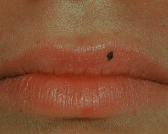 Melanotic Macule Symptoms Causes Treatment February 2022 Melanotic Macule Symptoms Causes Treatment February 2022
