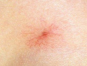 Healthoolspider angioma photos | Healthool