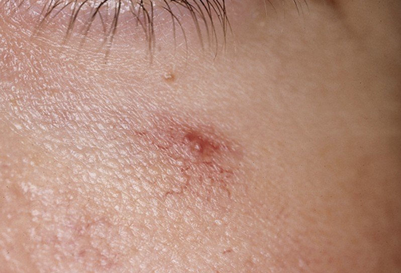 Spider Angioma - Symptoms, Causes, Pictures, Treatment - (2018 - Updated)